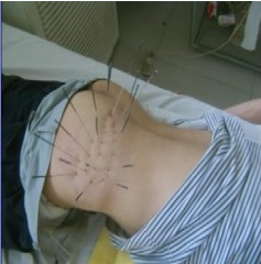 尖锐湿疣的穴位按摩治疗