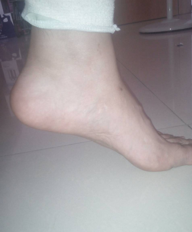 跟骨病的症状