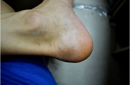 跟骨病检查诊断有哪些
