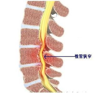 尖锐湿疣的的症状表现