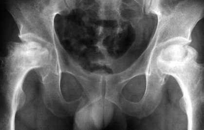 左大腿外侧疼